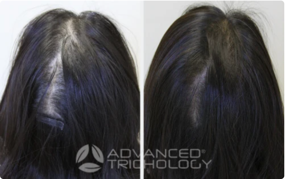 Advanced Trichology DHT Blocker with Immune Support 120 Tabs 30 Days Supply (Hair Loss Supplement)